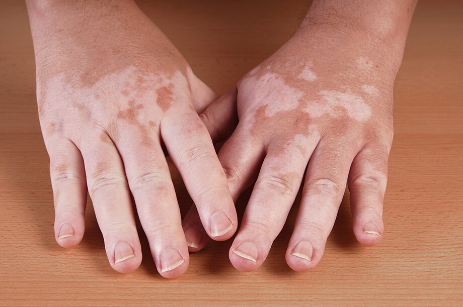 Izguba kožnega pigmenta – vitiligo