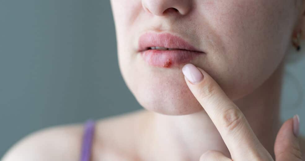 Kako prepoznati herpes?
